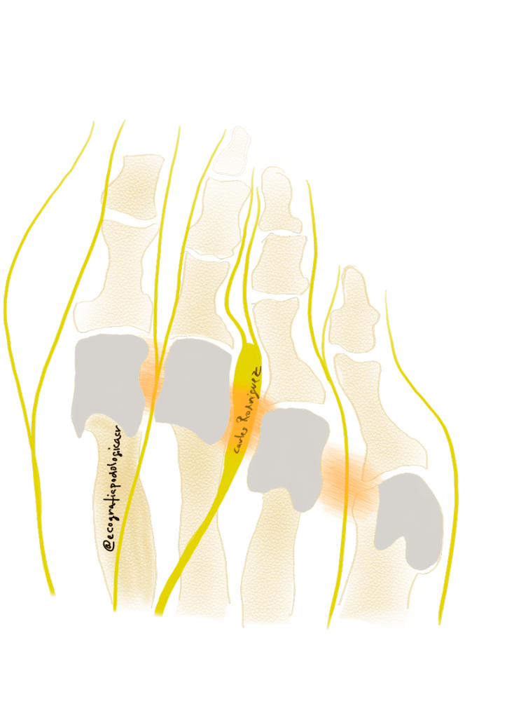 neuroma de morton